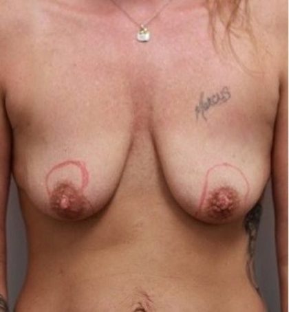 Breast Lift Before & After Patient #1261