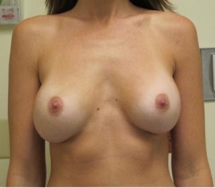 Breast Revision Before & After Patient #1266