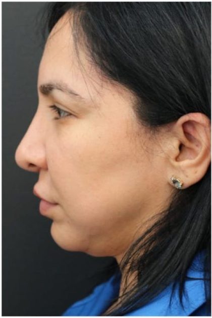 Jawline Filler Before & After Patient #1325