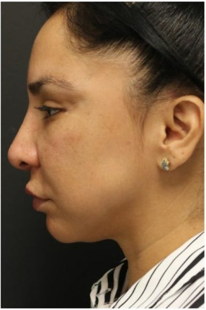 Jawline Filler Before & After Patient #1325