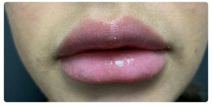 Lip Augmentation Before & After Patient #1203