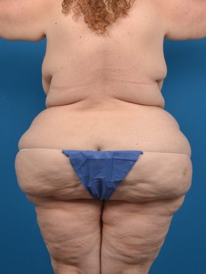 Liposuction Before & After Patient #1299