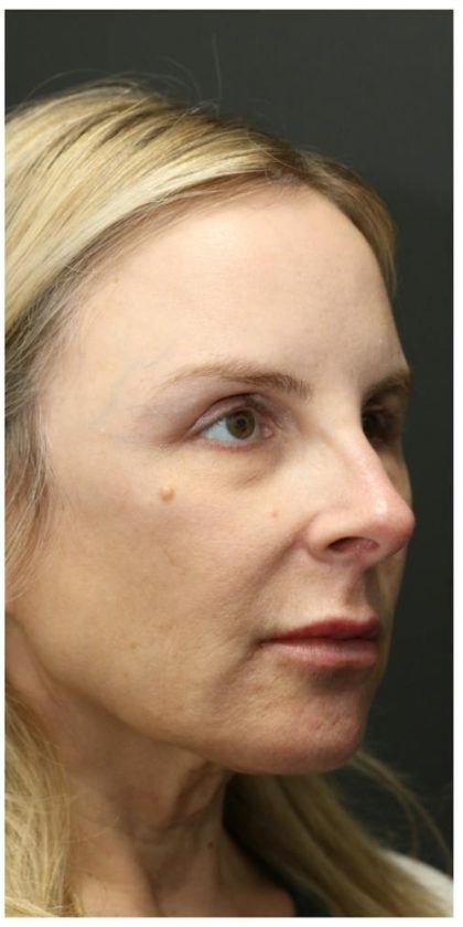 Liquid Facelift Before & After Patient #1326