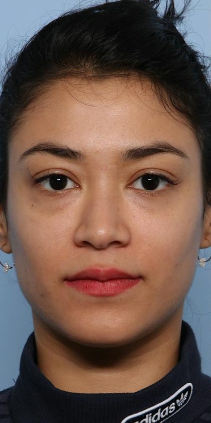 Liquid Rhinoplasty Before & After Patient #1329