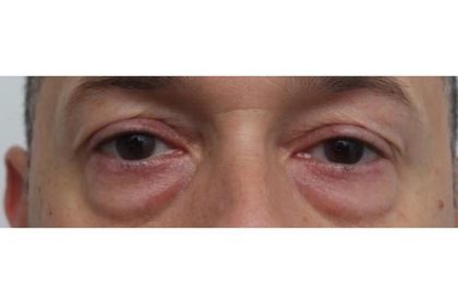 Eyelid Surgery Before & After Patient #1174