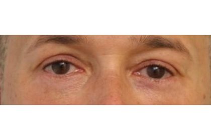 Eyelid Surgery Before & After Patient #1174