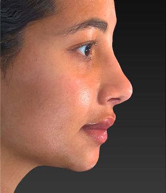 Rhinoplasty Before & After Patient #2826