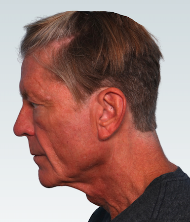 Male Facelift Before & After Patient #2845