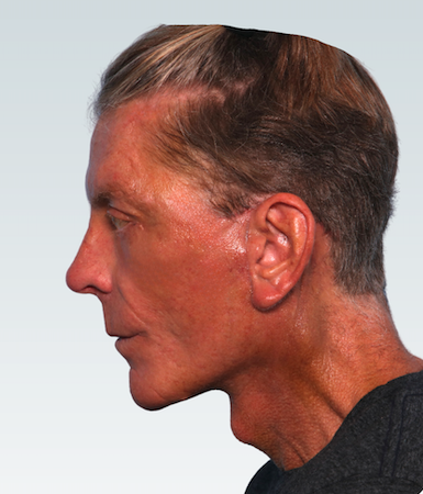 Male Facelift Before & After Patient #2845